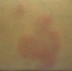 A single lesion of erythema nodosum