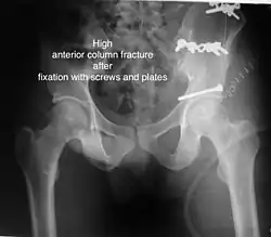 High anterior column fracture after fixation with screws and plates