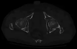 Axial CT image (viewed on bone windows) of a complex comminuted left acetabular fracture involving both anterior and posterior columns.