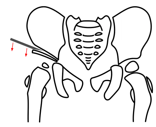 Acetabuloplasty, Step 2: Tilting the acetabular fragment downward