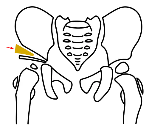 Acetabuloplasty, Step 3: Insertion of the bone wedge