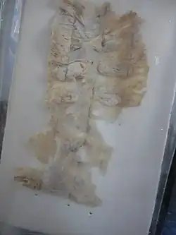 Amoebic intestinal ulcer caused by E. histolytica