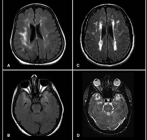MRI demonstrating white matter changes in the brain of patients with CADASIL