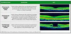 Classification of Vitreomacular Adhesion, Traction, and Macular Hole (IVTS 2013)