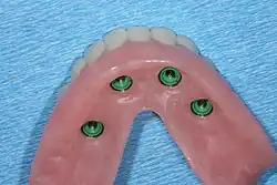 lower denture implant housing