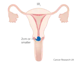 Stage IB1 cervical cancer