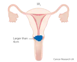 Stage IB3 cervical cancer