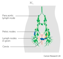 Cervical cancer stage IIIC1