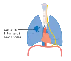 Stage IIB lung cancer