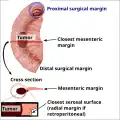 Edges and margins of an intestinal tumor
