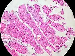 Hepatocellular carcinoma cells stained pink