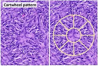 Cartwheel pattern: Center points that radiate cells or connective tissue outward