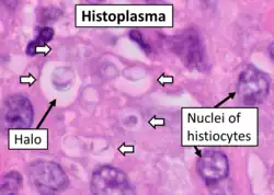 Histopathology of Histoplasma capsulatum, H&E stain, showing organisms surrounded by halos, in a granuloma of epithelioid histiocytes