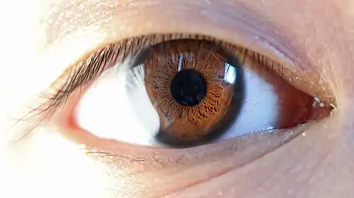 A thick, dark, limbal ring is seen as an attractive feature.