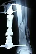 X-ray of the open fracture of the left leg; the external fixator was installed ca. 24 hrs. in hospital.