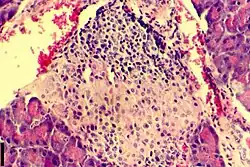 A histological image of an inflammatory infiltration of the islets of Langerhans of the pancreas