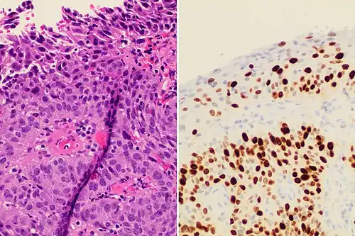 Invasive cervical squamous cell carcinoma on H&E histopathology and Ki-67 immunohistochemistry. The latter correlates well with the degree and level of dysplasia.[77]