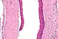 High magnification of an odontogenic keratocyst.