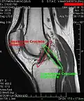 Cruciate ligaments