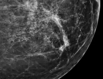Mammogram microcalcifications in ductal carcinoma in situ