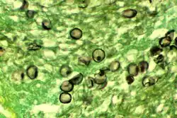 "P. jirovecii" cysts in tissue