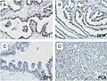 Microscopic examination of different types of prostate tissues (stained with immunohistochemical techniques): A. Normal (non-neoplastic) prostatic tissue (NNT). B. Benign prostatic hyperplasia. C. High-grade prostatic intraepithelial neoplasia. D. Prostatic adenocarcinoma (PCA).