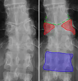 Butterfly vertebra (red). Normal vertebra for comparison (blue).
