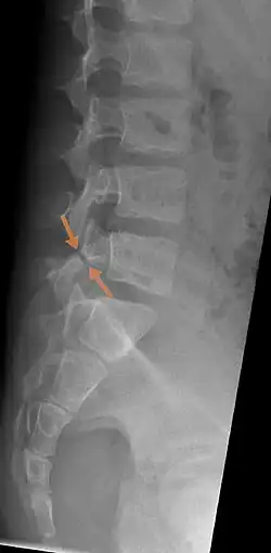 Arrows show break in pars interarticularis at L5. X-Ray of lumbar spine, lateral projection, in an 11-year-old boy