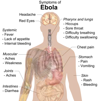 Symptoms of Ebola virus disease