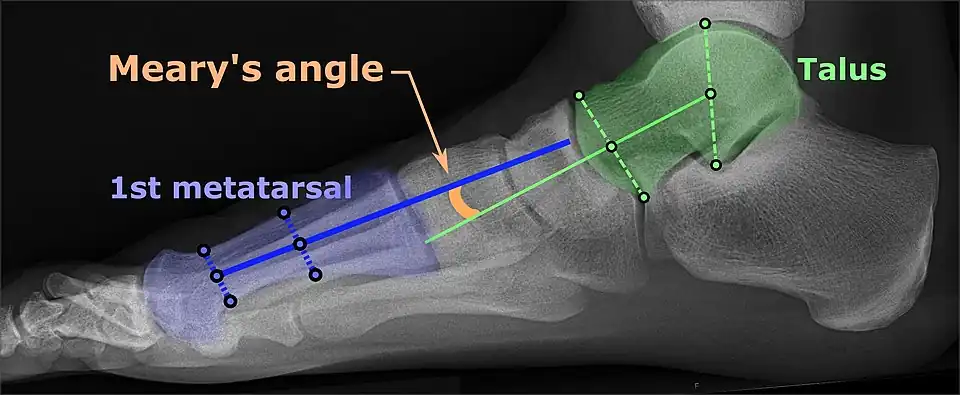 Same lateral X-ray showing the measurement of Meary's angle, which is the angle between the long axis of the talus and first metatarsal bone.[17] This example is slightly convex downward. An angle greater than 4° convex upward is considered pes cavus.[17]