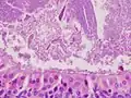 Histopathology of Warthin tumor in the parotid gland. Higher magnification of a file "Warthin tumor (1).jpg". H&E stain.